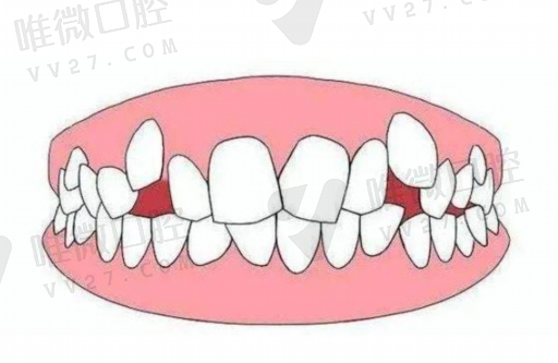 单晶和自锁托槽的区别（单晶体托槽）(图1)